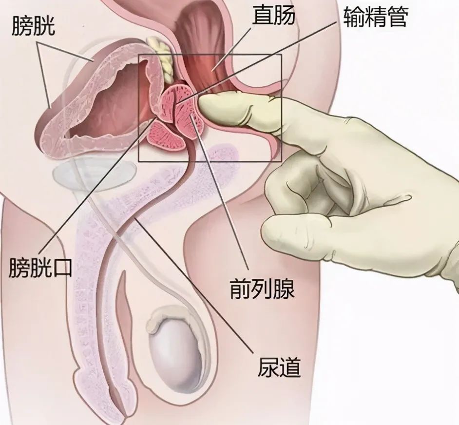 前列腺炎與陽痿，早泄，射精無力不得不說的事(圖1)
