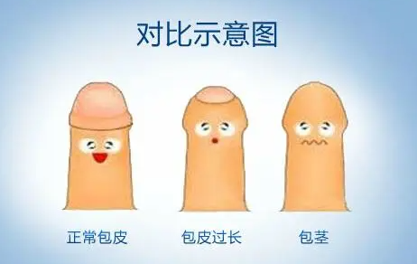 包皮過長割不割？成了很多男性朋友糾結的問題！(圖2)